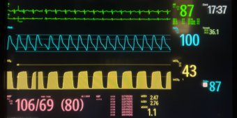 Photo of a hospital monitor in healthcare showing electrocardiogram and anesthesiology machine showing heart beat and life of patient with normal blood pressure